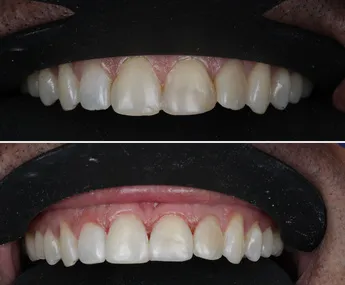 Smile correction example