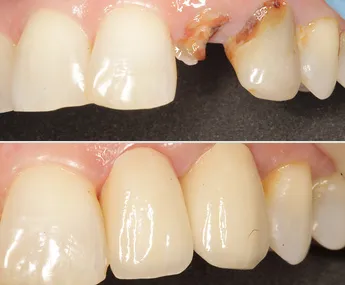 Smile transformation example