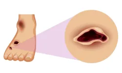 Leg ulcers & Wound Healing