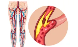 Peripheral Arterial Disease