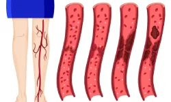 Vein Thrombosis
