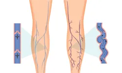 Varicose Veins