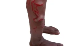 Vascular Malformations