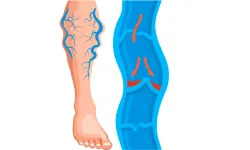 Vascular Diseases