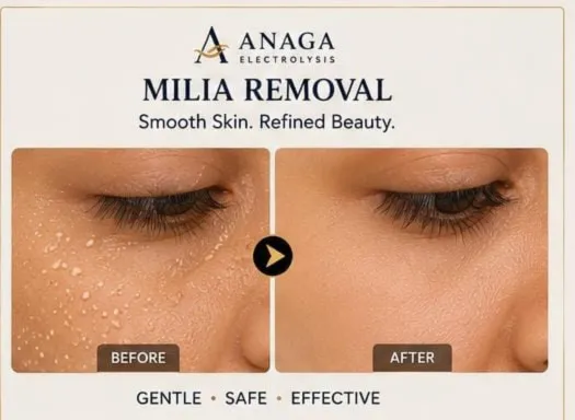 Milia extraction facial treatment
