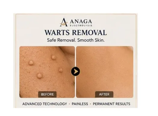 Professional wart removal treatment
