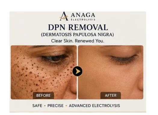 DPN removal skin treatment