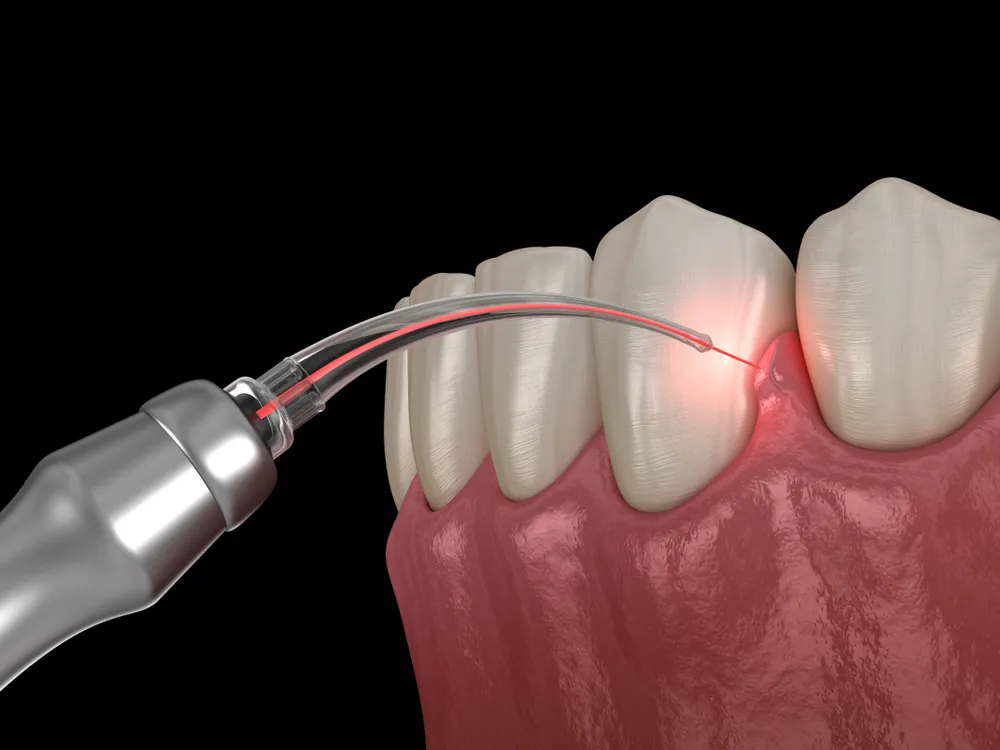 Laser Flap Surgeries