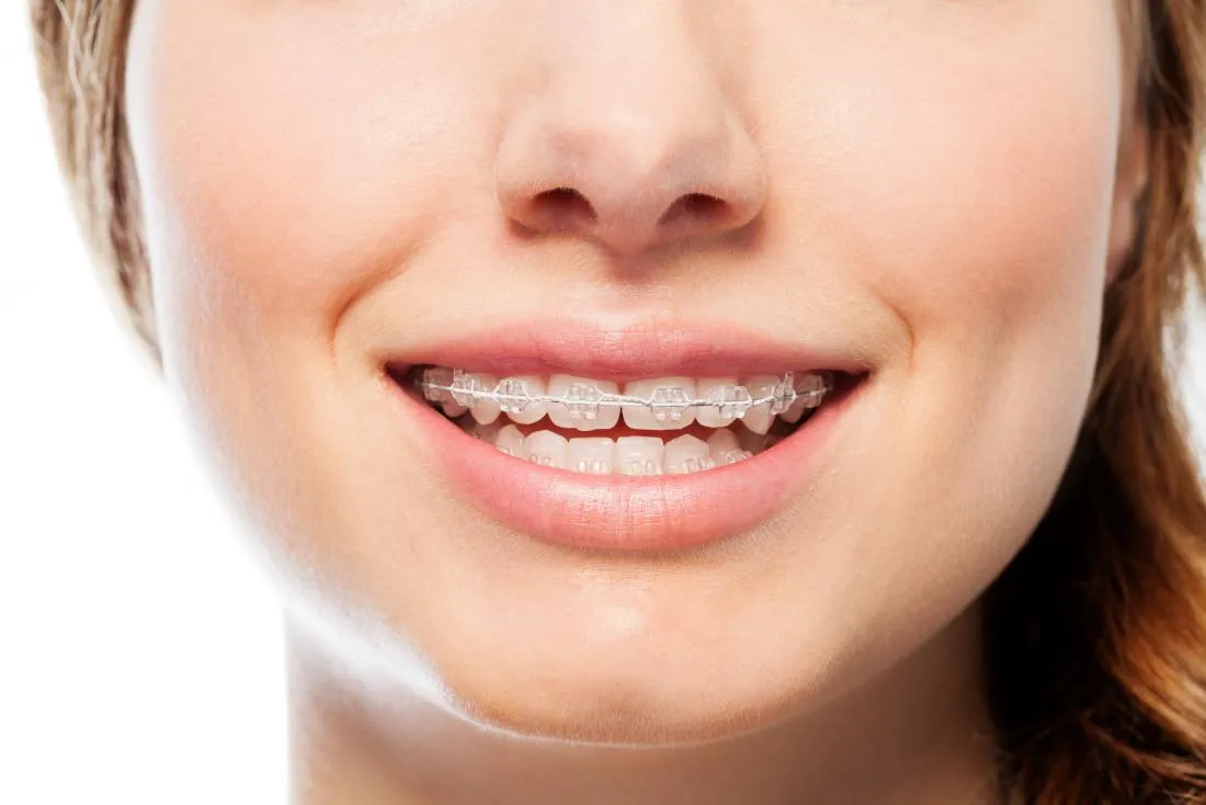 Orthodontic Treatment
