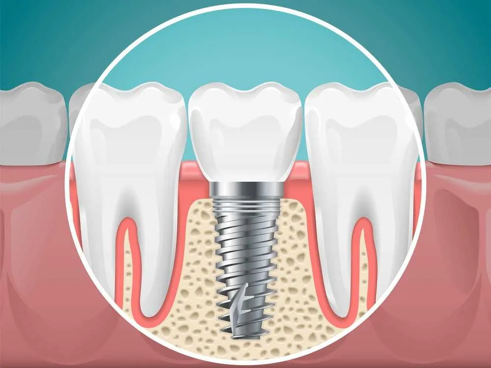 Dental Implants