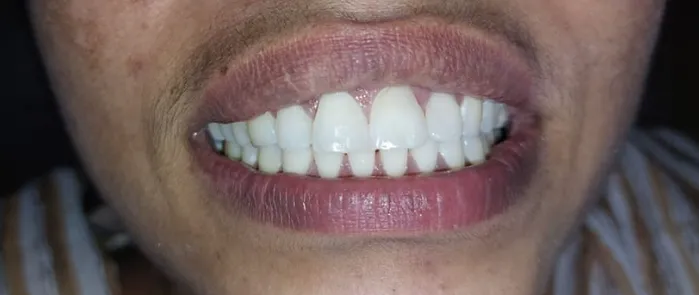 After Treatment
