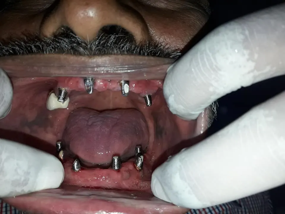 Before Treatment