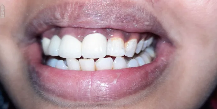 After Treatment