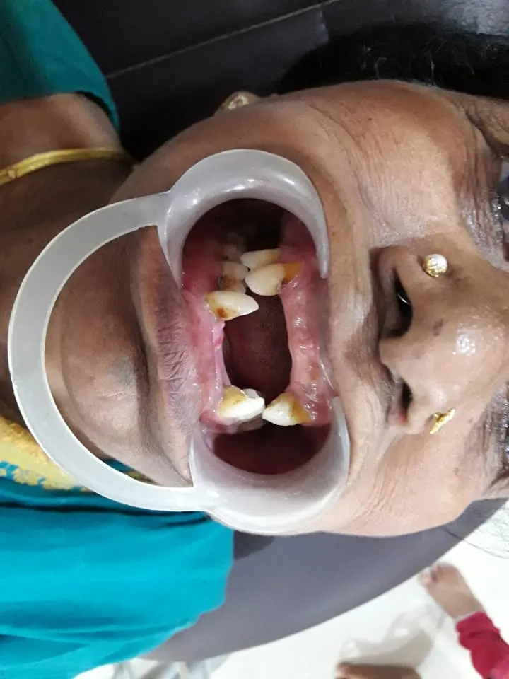 Before Treatment
