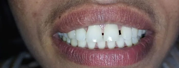 Before Treatment