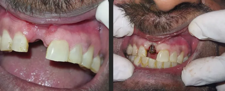 Before Treatment