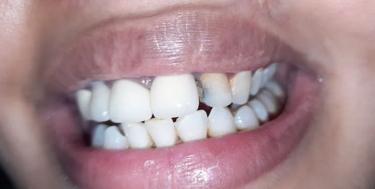 Before Treatment