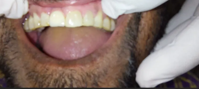 After Treatment